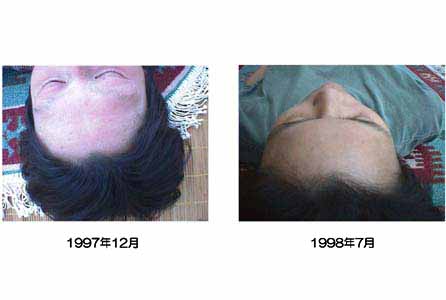 姿斉：アトピー性皮膚炎の改善例